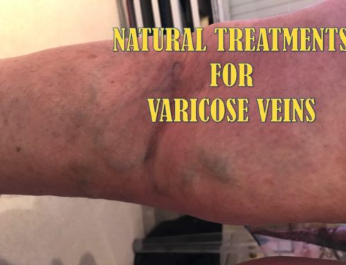 NATURAL TREATMENTS FOR VARICOSE VEINS